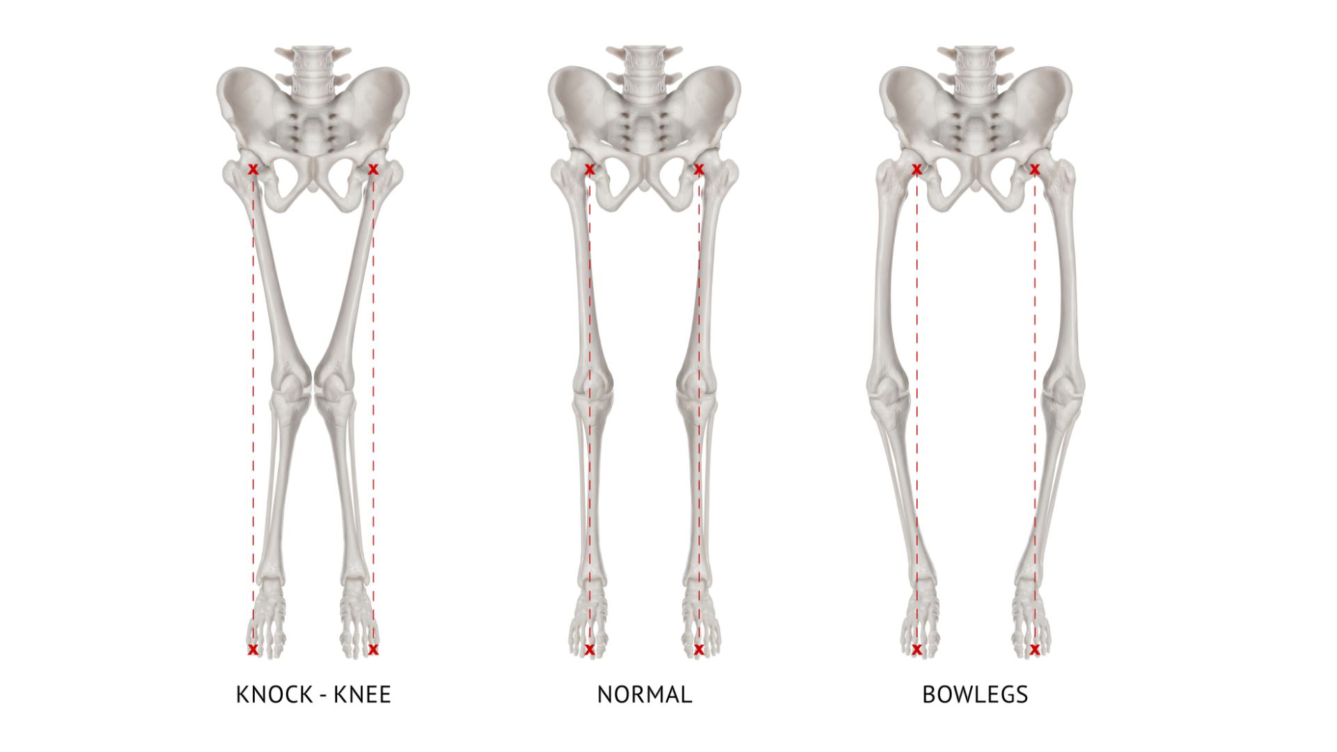 alignment - Mr Navjot Bhangoo - Orthopaedic Surgeon