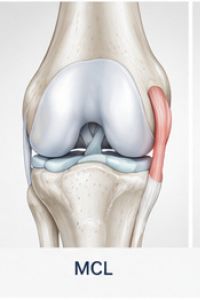 Anatomical illustration of the medial collateral ligament (MCL)